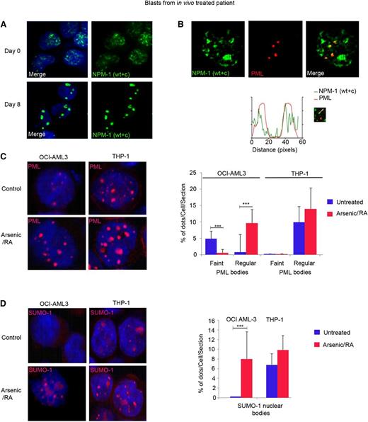 Figure 4. Combination of RA and arsenic restores PML and SUMO-1 nuclear body formation. (A-B) Primary leukemic blasts from one NPM1 mutated AML patient on days 0 and 8 after in vivo treatment with RA/arsenic were analyzed by confocal miscroscopy. NPM1 was stained with anti-NPM1 (WT + c) antibody (green); PML was stained with anti-PML antibody (red). (C-D) OCI-AML3 cells (left panels) and THP-1 cells (right panels) treated with RA/arsenic for up to 48 hours and analyzed by confocal miscroscopy. (C) Treatment of OCI-AML3 cells with RA/arsenic leads to PML nuclear body reorganization. (D) Treatment of OCI-AML3 cells with RA/arsenic leads to SUMO-1 nuclear body formation. The results (C-D) depict one representative of 3 independent experiments. Graphs show quantification of PML and SUMO-1 NBs, as averages of one Z-section/cell from 30 different cells. Significant P values are indicated by asterisks.