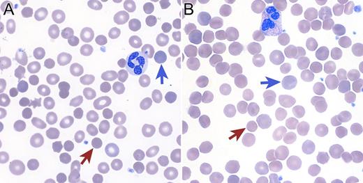 A 73-year-old man without prior personal or family history of anemia developed a chronic hemolytic anemia characterized by an absolute reticulocyte count of 347 000/mm3 (13%) and spherocytic red-cell morphology (see panel A). Antiglobulin testing was negative but osmotic fragility testing was positive. Bone marrow biopsy was hypercellular with a decreased M:E ratio and dysplastic erythroid precursors. Standard cytogenetics reported an interstitial deletion of 5q13-33 and a gain of material on 14q22. High-density single-nucleotide polymorphism array–based karyotyping revealed 6 deletion regions on chromosome 5 and 3 deletion regions on chromosome 14, including loss of 14q23.1-24.2. Taken together with the cytogenetic studies, a complex rearrangement of chromosomes 5 and 14 resulted in the net losses. One of the 14q-deletion regions contains SPTB, rendering this patient haploinsufficient for the gene encoding the β-spectrin protein. Thus, this patient’s complex rearrangement resulted in a phenocopy of hereditary spherocytosis type 2 (OMIM 182870) (see panel B). This patient’s case demonstrates the clinical utility of high-density array karyotyping to define atypical clinical presentations and highlights the variable natural history of myelodysplastic syndromes. / (Panel A) Blood smear from a 73-year-old man with a myelodysplastic syndrome and acquired spherocytosis. (Panel B) Blood smear from a 65-year-old man with autosomal-dominant hereditary spherocytosis. Red arrows indicate microspherocytes and blue arrows indicate polychromatophilic cells (reticulocytes).