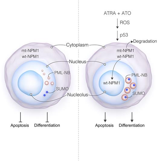 Proposed model of ATRA/ATO actions in NPM1-mutant cells. Mutant NPM1 leads to delocalization of both mutant (mt) and wild-type (wt) NPM1 (ie, from their normal nucleolar distribution to the cytoplasm). NPM1 mutation also results in disorganization of PML nuclear bodies (PML-NB), manifested by small size, heterogeneous appearance, nucleoplasmic localization, and dissociation from SUMO-1. These events, through mechanisms that have yet to be determined, disrupt both cell differentiation and apoptosis, contributing to leukemogenesis. Exposure of mutant NPM1-expressing cells to ATRA + ATO triggers pronounced oxidative stress and p53 activation, culminating in mutant NPM1 degradation. The loss of mutant NPM1 leads in turn to re-localization of wt NPM1 to the nucleolus, accompanied by reversal of PML-NB disorganization (eg, reflected by larger size, more homogeneous appearance, and restoration of the SUMO-1 association). These events culminate in leukemic cell differentiation and/or cell death. Professional illustration by Luk Cox, Somersault18:24.