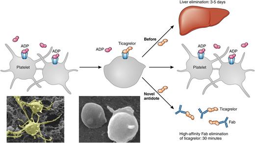 The figure illustrates platelets activated by ADP that aggregate. After treatment with the ADP antagonist ticagrelor, aggregation is limited. If bleeding occurs or the patient needs to undergo urgent surgery, elimination of ticagrelor is currently dependent on liver elimination requiring 3 to 5 days. With the high-affinity Fab ticagrelor antidote, the elimination can be achieved within 30 minutes. After elimination of ticagrelor, the platelets can aggregate in response to ADP again and bleeding can be mitigated. Original magnification ×10 400. Professional illustration by Patrick Lane, ScEYEnce Studios.