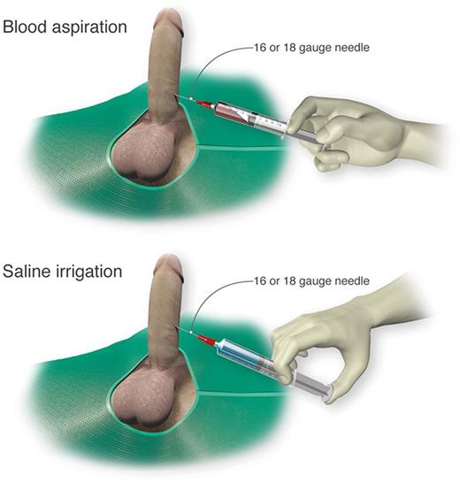 Figure 3. Cavernosal aspiration and irrigation of the penis. For treatment of an acute major ischemic priapism episode, a 16 or 18 gauge needle is inserted into the corpus cavernosum to aspirate blood, irrigate with saline, and inject sympathomimetics as necessary. Professional illustration by Luk Cox, Somersault18:24.