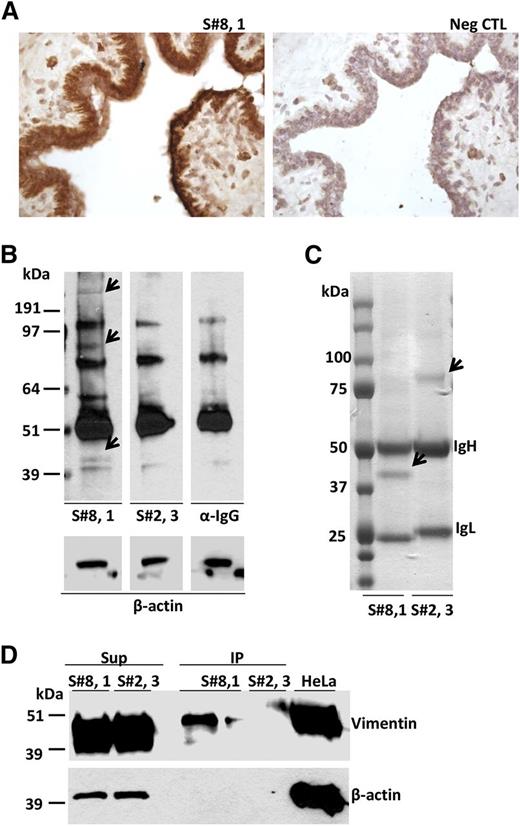 Figure 4. Subset #8 CLL BCR binds to autoantigens, including vimentin, on breast epithelial cells. (A) CLL 657 (S#8,1) IgG binding to breast epithelium. (B) SDS-PAGE electrophoresis of breast tissue protein extracts probed with CLL mAbs, CLL657 (S#8,1), and P326 (S#2,3), or with secondary Ab only (anti-human IgG). The arrows indicate breast tissue proteins specifically recognized by subset #8 CLL657 (S#8,1) mAb. The subset #2 P326 (S#2,3) mAb did not exhibit differential protein recognition relative to control (α-IgG). (C) CLL657 (S#8,1) and P326 (S#2,3) CLL mAbs were used to immunoprecipitate proteins from breast tissue. The immunoprecipitated proteins were resolved by SDS-PAGE electrophoresis, and thereafter the gel was subjected to Coomassie blue staining. The arrows indicate differentially immunoprecipitated proteins between CLL657 (S#8,1) and P326 (S#2,3) mAbs that were subjected to nLC-ESI-MS/MS analysis (supplemental Table 7). (D) IP and Sup samples from breast tissue extracts using CLL657 (S#8,1) and P326 (S#2,3) CLL mAbs were electrophoresed in 10% SDS-PAGE along with lysate of HeLa cells, and subsequently immunoprobed with anti-vimentin and anti–β-actin antibodies. Vimentin was recognized and immunoprecipitated by the subset #8 CLL657 (S#8,1) mAb. IP, immunoprecipitate; Sup, supernatant; Neg CTL, negative control.