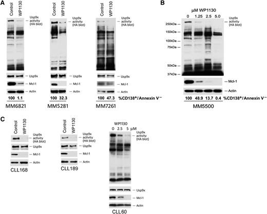 Figure 2. WP1130 inhibits DUB activity in primary B-cell tumors. (A) Top: primary myeloma cells were treated with 5 μM WP1130 for 4 hours before assessing DUB activity as described in the legend for Figure 1. The HA-labeled Usp9x protein is denoted. Middle: total protein levels for Usp9x, Mcl-1, and β-actin were also assessed by immunoblotting. Bottom: after 24 hours, aliquots of the same cells were subjected to staining with annexin V-fluorescein isothiocyanate (FITC)/propidium iodide and analyzed by flow cytometry. Viability of untreated control cells was set at 100%, and relative reduction in survival in WP1130-treated cells is noted below each blot. (B) Plasmacytoma cells from a newly diagnosed patient were treated with 0, 1.25, 2.5, and 5.0 µM WP1130 for 4 hours before measuring DUB activity by HA-UbVS labeling, and the labeled DUBs were visualized by anti-HA immunoblotting. Mcl-1 and actin protein levels were also measured by blotting. Viability of CD138+ cells was determined as described in (A). (C) Primary CLL cells were left untreated or were treated with WP1130 as described above. Patient CLL60 cells were treated with the WP1130 concentration indicated before assessing DUB activity and Usp9x, Mcl-1, and β-actin expression by immunoblotting.