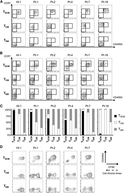 Figure 4. Unidirectional generation from HTLV-1–infected TSCM cells to TCM and TEM cells with rapid proliferation capacity. Data from culture of sorted TSCM, TCM, and TEM cells with 25 ng/mL recombinant human IL-7 and CFSE dilution for 2 weeks are presented. (A) FACS analyses of sorted samples in each case before in vitro culture. (B) FACS plots show sorted populations from a HI, HTLV-1 carriers, and ATL patients alter their phenotype. (C) The proportions of resulting phenotypic TSCM, TCM, and TEM cells shown in (B) are summarized. (D) The correlations of phenotypic alterations based on CD45RA level with proliferation ability are presented. The proliferation ability of each sorted population is assessed by the intensity of CFSE.