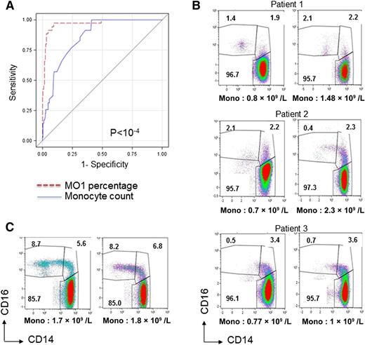 Figure 5. Comparison between monocyte subset profile and monocyte count diagnosis. (A) ROC curves of the “MO1 percentage >94.0%” and “monocyte count >1 × 109/L” criteria to identify CMML at initial workup in the validation cohort. The difference between the 2 curves was highly significant (P < .0001, χ2 test). (B) Monocyte subset repartition analyzed in 2 independent samples obtained from 3 patients classified as having MDS and showing a fluctuating monocyte count of ∼1 × 109/L that precludes their classification as CMML according to the WHO criteria. (C) Monocyte subset repartition analyzed in 2 independent samples obtained from a patient who could be classified as having CMML according to the WHO criteria but who, based on cytologic and molecular analyses, demonstrates sideroblastic anemia with monocytosis.