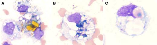 A 50-year-old woman with a right cerebellopontine-angle schwannoma developed a chain of complications after multiple surgeries for tumor resection including intracerebral and subarachnoid hemorrhage, hydrocephalus, and fungal meningitis with subarachnoid pyogenic loculations. After 2 months of routine monitoring, cerebrospinal fluid (CSF) examination revealed increased red blood cells (RBCs), neutrophils, monocytes, and macrophages. Wright-Giemsa staining revealed golden brown rhomboid crystals of hematoidin (panel A) and coarse granules of hemosiderin (panel B) in the macrophages (siderophages). Along with the presence of macrophages with ingested RBCs (erythrophages; panel C), these findings indicate an acute and chronic hemorrhage. / Hematoidin is a hemoglobin degradation product biochemically similar to unconjugated bilirubin, which can be present both as extracellular and/or intracellular forms (within histiocytes). It usually manifests as radially arranged star-shaped clusters, spherules, amorphous masses, or rhomboids in association with hemosiderin. It is formed after extravasation of RBCs in a closed compartment (reducing environment and low-oxygen tension). It has been documented in CSF 2 weeks after intracranial hemorrhage. In contrast, siderophages have been detected within 2 to 4 days (as intracellular coarse granules) and erythrophages within 1 to 2 days after subarachnoid hemorrhage. The presence of hematoidin, siderophages, and erythrophages indicate true hemorrhage as opposed to traumatic tap.