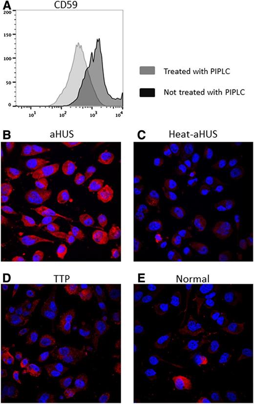 Figure 1. C5b-9 deposition on PIPLC-treated human EA.hy926 cells. (A) Flow cytometric analysis of CD59 expression on ADP-activated EA.hy926 l cells treated with PIPLC vs untreated EA.hy926 cells. After trypsinization, endothelial cells were recovered in cell culture medium at 37°C for 30 minutes, treated with PIPLC, and then stained with anti-CD59 antibody. Reduced CD59 expression on PIPLC-treated cells is shown. (B-E) Confocal microscopy of ADP-activated EA.hy926 cells treated with PIPLC and stained with C5b-9 (depicted in red) and 4,6 diamidino-2-phenylindole (blue) as nuclei cell counterstaining. Magnification 40x. C5b-9 deposition is shown after incubation with aHUS serum (B) compared with heat-inactivated aHUS serum (C), TTP serum (D) and normal serum (E). PIPLC: Phosphatidylinositol-specific phospholipase C; aHUS: atypical hemolytic uremic syndrome; Heat-aHUS: heat inactivated atypical hemolytic uremic syndrome; TTP: thrombotic thrombocytopenic purpura.
