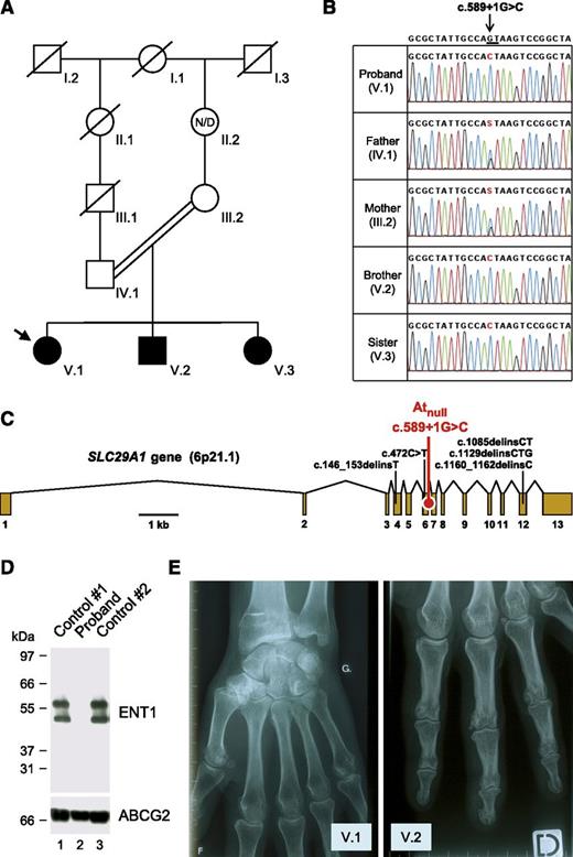 Figure 1. Identification of a SLC29A1-null mutation responsible for the Atnull blood type in a family of European ancestry. (A) Pedigree of the family of the proband (arrow); black-filled symbols represent individuals with the Atnull blood type; N/D, no data. (B) Detail of SLC29A1 sequencing in the proband, her parents, and siblings, showing the segregation of the c.589+1G>C mutation in her family; reference sequence (NC_000006) is indicated at the top; the highly conserved dinucleotide GT at the 5′ end of intron 6-7 is underlined; and of note, the c.589+1G>C mutation is associated with the major allele of rs45458701 and the minor allele of rs45573936 in the proband’s family. (C) Exon-intron diagram of human SLC29A1 gene (based on NM_004955) highlighting the location of the splice mutation c.589+1G>C found in the proband’s family (red) and 5 other loss-of-function mutations found in the heterozygous state in the Exome Aggregation Consortium data (black); exons are numbered 1 to 13. (D) The SLC29A1-encoded nucleoside transporter ENT1 is absent in the red cells of the proband. Red cells membranes were prepared from the proband (lane 2) and 2 controls (lanes 1 and 3), resolved by polyacrylamide gel electrophoresis under reducing conditions without heat denaturation, and immunoblotted with an antibody raised against a peptide from the extreme N terminus of the ENT1 transporter (upper); as a control, the western blot membrane was reprobed with an antibody to the ABCG2 transporter (lower). (E) X-ray views of the left hand of the proband (V.1; 49 y) and the right hand of her brother (V.2, 37 y), showing the presence of small calcifications around the metacarpo- and interphalangeal joints.