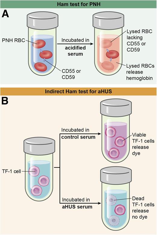 (A) The Ham test incubates PNH red cells with acidified serum, which lyses cells that lack glycosylphosphatidylinositol (GPI)-linked complement inhibitors such as CD55 and CD59. (B) The indirect Ham test incubates control or aHUS serum with TF-1 cells that lack these complement regulators. Complement-induced cell death prevents the conversion of WST-1 into formazan, a red dye. RBC, red blood cell. Professional illustration by Ken Probst, XavierStudio.