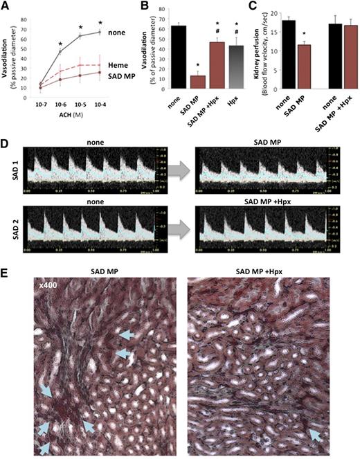 Figure 5. Erythrocyte MP heme induces endothelial damage and vasoocclusions. Mouse mesenteric resistances arteries were perfused with PSS alone, and initial diameters provided controls. Arterioles were then preconstricted with phenylephrine, and endothelium-dependent vasodilation was assessed in response to ACH (10−7 to 10−4 M). Arterioles were washed, constricted again with phenylephrine, and perfused with either SAD erythrocyte MPs (300 MPs/μL), or heme (100 nM) at 75 mm Hg pressure and 20 μL/s flow. (A) Endothelium-dependent vasodilation in response to increasing ACH doses (10−7 to 10−4 M) was quantified and expressed as percentage of passive diameter. *P < .05 vs SAD MPs (brown line) and heme (red dashes). (B) Some SAD MPs were pretreated with Hpx (1 µM, 1 hour) prior to perfusion. *P < .05 vs control; #P < .05 vs SAD MPs alone (+ none). To evaluate vasoocclusions in vivo, we injected 2 × 104 SAD erythrocyte MPs per mouse (brown) intravenously to SAD transgenic mice. We monitored kidney vasoocclusions by recording echo-Doppler velocity waveforms (C-D) and hemodynamic parameters. In each SAD mouse, we recorded the mean blood flow velocity (cm/s) in the right renal artery (blue line in Doppler velocity waveforms), before (none) or after intravenous injection of 2 × 104 SAD mouse erythrocyte MPs. Some MPs were preincubated with Hpx as previously described prior to injection. *P < .05 vs none. (E) Histologic analysis by Masson trichrome staining of SAD kidneys, 5 minutes after injection of SAD MPs, alone or preincubated with Hpx. Arrows show erythrocytes, with larger deposits and vascular congestion in SAD.