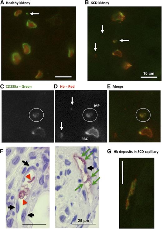 Figure 6. Immunohistochemistry for CD235a (glycophoryin) and Hb in human renal biopsies. Fluorescence immunohistochemistry in human normal peritumoral control (A) and SCD (B-G) kidney sections (n = 2) reacted with anti-human Hb and anti-human CD-235a IgG. High magnification micrographs were taken from tubulo-interstitial area (×600; white bars = 10 μm). White arrows identify CD235a+ or Hb+ particles. White circles surround a double-stained MPs. Note the submembrane deposition of Hb within SCD erythrocytes (C-E). (F) Immunohistochemistry with anti-human Hb IgG (×400). Black arrows identify counterstained capillary endothelial cell nuclei. Green arrows show Hb-positive cell fragments, and red arrowheads point at intact erythrocytes. Red stain reveals Hb in intact erythrocytes or deposited at the surface of nucleated vascular wall cells. (G) Fluorescence immunohistochemistry (×600) showing vascular Hb deposits.