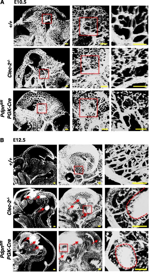 Figure 2. Hemorrhages develop within tortuous vascular networks in CLEC-2- and podoplanin-deficient mice. Whole mount immunostaining of PECAM-1+ blood vessels in whole embryonic heads of Clec-2−/− and Pdpnfl/flPGK-Cre embryos at (A) E10.5 and (B) E12.5 (Clec-2−/−; E10.5, n = 3; E12.5, n = 3; Pdpnfl/flPGK-Cre; E10.5, n = 4; E12.5, n = 3) and littermate controls (E10.5, n = 4; E12.5, n = 5). PECAM-1+ vessels in the whole embryonic head are shown as a sagittal section (z-dimension = 100 μm) taken from a 3-dimensional reconstructed image of optical sections (A, left). Red boxes in the left panel mark areas of higher magnification depicted in the middle panel where a 3-dimensional image shows abnormally patterned, tortuous capillaries branching off a large cerebral vessel in Clec-2−/− and Pdpnfl/flPGK-Cre mice (z-dimension = 650 μm). Red boxes in the second panel depict a further magnified area displayed as a single sagittal section in the third panel (z-dimension = 250 μm). (B) At E12.5, sagittal sections taken from 3-dimensional movies (supplemental Videos 1-3) show hemorrhages located throughout the fore-, mid-, and hindbrain in CLEC-2-deficient and Pdpnfl/flPGK-Cre mice only (left, red arrows). A 3-dimensional reconstruction of optical sections shows a clear well-patterned PECAM-1-stained vascular network in wild-type mice compared with the disorganized vascular network in Clec-2−/− and and Pdpnfl/flPGK-Cre mice (middle, red arrows mark hemorrhages; z-dimension = 1500 μm). Red boxes in the middle panel mark areas of higher magnification depicted in the third panel of cerebral capillaries branching off a major vessel leading to hemorrhage (outlined by a red dashed line) in Clec-2−/− and Pdpnfl/flPGK-Cre mice (z-dimension = 300 μm). Images were processed using Imaris software. Scale bars, 100 μm.