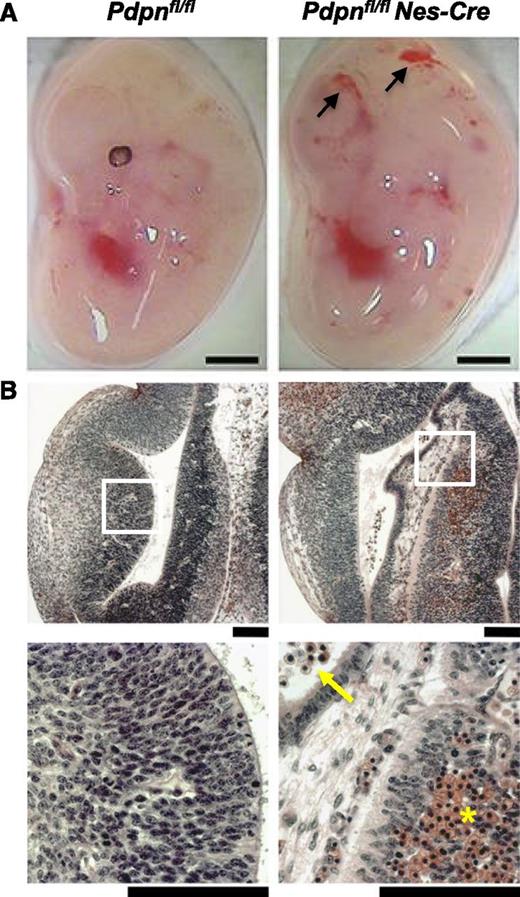 Figure 3. Loss of podoplanin in the neural tube causes cerebral hemorrhages. (A) Pdpnfl/flNes-Cre embryos develop hemorrhages in the brain by E12.5 (n = 4), whereas Pdpnfl/fl littermates appear normal (n = 3). Scale bars, 1 mm. (B) H&E coronal sections from E12.5 embryo heads of Pdpnfl/fl (n = 3) and Pdpnfl/flNes-Cre (n = 4) embryos. White boxes in the middle panel magnify areas in the bottom panel. Yellow arrows indicate reticulated red blood cells in the ventricles, and yellow asterisks (*) marks an area of hemorrhage in the neuro-epithelium. Scale bars, 50 μm.