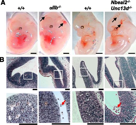 Figure 6. Evidence for a role for both platelet aggregation and secretion in maintaining cerebral vascular integrity. (A) Mice deficient in the major platelet integrin subinit αIIb present with cerebral hemorrhaging at E12.5 (black arrows; 6 of 6 αIIb−/− embryos). Hemorrhages were also observed in 6 of 8 embryos at E12.5 from mice in which both platelet α-granule and dense-granule secretion is abolished (black arrows; Nbeal-2−/−Unc13d−/−). Scale bars, 1 mm. (B) H&E coronal sections from E12.5 embryo heads show the accumulation of erythrocytes in the ventricles of αIIb−/− (n = 6) and Nbeal-2−/−Unc13d−/− (n = 6 of 8) embryos (red arrows), whereas only a minor hemorrhage was observed in 1 of 17 wild-type littermate controls (+/+). White boxes show magnified areas in the lower panel. Scale bars, 50 μm.