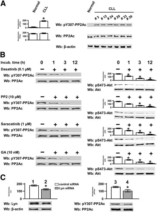 Figure 3. Phosphorylation state and protein level of the catalytic subunit of PP2A in CLL cells. (A) Whole B-cell lysates from 6 normal donors and from all CLL patients were analyzed by western blot (Wb) analysis with anti-pY307-PP2Ac antibody, and the blots were reprobed with anti-PP2Ac antibody as well as anti-β-actin antibody as a loading control (left panel). Wb analysis representative of 1 normal donor and CLL patients (patients 3, 12, 24, 29, 33, and 39) are shown in the right panel. (B) Freshly isolated CLL cells from 14 patients were cultured in the absence or presence of 0.1 µM dasatinib, 10 µM PP2, 1 µM saracatinib, or 10 nM GA at different time points. After such treatment, cells were either (1) lysed and analyzed by Wb analysis with anti-pY307-PP2Ac antibody and the blots were reprobed with anti-PP2Ac antibody (left panels) or (2) subject to a phosphatase activity assay by using pAkt, obtained by immunoprecipitation from CLL cells, for 10 minutes at 37°C. In the latter case, the samples were analyzed by Wb analysis with anti-p-Akt and anti-Akt antibodies. Pooled densitometric analyses (arbitrary units) of the Wb bands of the immunoblots are shown (right panels). Compared with the control, changes were statistically significant (*P < .01). (C) Freshly isolated CLL cells were transfected by nucleofection with either the negative control or Lyn-siRNAs and cultured for 48 hours in complete medium. Cell lysates underwent Wb analysis with anti-Lyn antibody (lanes 1and 2) and anti-pY307-PP2A (lanes 3 and 4) and were reprobed, after stripping, with anti-β-actin and anti-PP2Ac antibodies, respectively, as loading controls. Pooled densitometric analyses (arbitrary units) of the Wb bands of the immunoblots are shown (right panels). Compared with the control, changes were statistically significant (*P < .01) to assess the efficacy of siRNA technology.