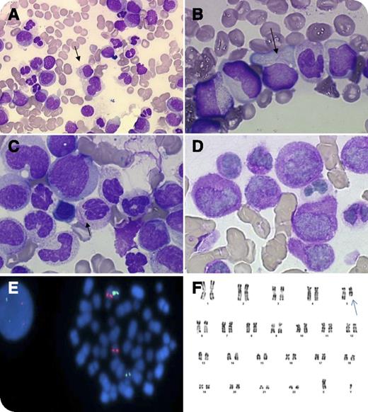 An 85-year-old man was admitted with a 4-week history of weakness, vertigo, weight loss, and pallor. Blood cell count showed 3 × 109/L leukocytes, 9 g/dL hemoglobin, 49 × 109/L platelets, and no disseminated intravascular coagulation. Cytological examination evidenced 8% blast cells in the peripheral blood and 77% abnormal promyelocytes in the bone marrow. The blasts’ cytoplasm had azurophilic granules and bundles of Auer rods (faggot cells). The nuclei were regular, irregular, or bi-lobed (panels A-C), typical of acute promyelocytic leukemia (APL). Cytochemical stains showed that blast cells strongly expresssed myeloperoxidase (100%) (panel D). The diagnosis of APL of French-American-British subtype M3 was made, and the patient received tretinoin. No response was observed, and the treatment was stopped. Fluorescence in situ hybridization excluded a promyelocyte leukemia–retinoic acid receptor alpha (RARA) fusion gene, another variant RARA translocation (panel E), and MLL gene rearrangement. Molecular analysis excluded the presence of promyelocytic leukemia zinc finger–RARA and signal transducer and activator of transcription 5b-RARA fusion transcripts. The karyotype showed a 5q deletion (panel F) suggestive of acute myeloblastic leukemia (AML) related to myelodysplasia. / In the context of severe heart disease and advanced age, the patient received only supportive care. This reports that the presence of bundles of Auer rods and typical APL morphology may occur in other forms of AML. The retinoid resistance and lack of RARA rearrangement led to further evaluation in this case, which provided an alternative diagnosis.