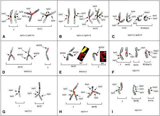 Figure 1. Partial karyotypes from patients 1-5 demonstrate the origin of CN aberrations of regions juxtaposed to 1q12. Successive hybridizations of chromosome pairs with different probe sets for 1p and 1q illustrate the CN changes or translocations in the respective chromosome arms. (A) Left bracket shows a normal pattern of probes on 1q (left) and 1p (right) on the normal chromosome 1 (patient 1). Right bracket demonstrates chromosome 1p triradial on the inv(1) showing branching of 1q12 (red) and 1 copy of 1q21 (green) to the left, whereas the same triradial chromosome on the right shows 2 copies of probes for 1p12 (green) and 1p13 (red). Triradials for 1p demonstrate the origin of a CN of 3 for 1p13. (B) Partial karyotype of patient 2 showing the same probe pattern as patient 1, with a normal pattern shown in the left bracket and gains of 1p in the right bracket. (C) Partial karyotype of patient 2 showing a novel whole-arm translocation of 1p to RC16q11 (aqua) with a CN gain of 1p. The left bracket shows a pattern of probes on inv(1), whereas the right bracket shows 1p translocation to RC16q11(aqua). Normal chromosome 1 is not shown. (D) Partial karyotype of patient 3 demonstrating the origin of CN gains of 2p and MYCN. The left bracket shows successive hybridization of a triradial of 2p. The triradial of 2p (left) originates on the der(1) showing the branching 1q12 probe (red). Rehybridization of same triradial (right) with a probe for MYCN (red) demonstrates an extra copy of MYCN and 1 copy of 1p12 (green) for the short arm. The right bracket shows normal 2 with probe for MYCN (red). Normal 1 and der(2) not shown. (E) Cell demonstrating triradial of 2p with FISH for MYCN and subsequently rehybridized with SKY (left bracket). The right bracket shows normal 2 by FISH and SKY. (F) FISH probes for 1q and 16q show whole-arm translocation of 1q12 to RC16(q11) (aqua). (G) Partial karyotype from patient 4 demonstrating CN gains of 1q21 originating on nonhomologous chromosome. A normal FISH pattern on chromosome 1 in left bracket. In the right bracket, a triradial of 1q12 (red) and 2 signals for 1q21 (green) on the der(2) demonstrate the origin of the 1q21 CN gain is the der(2). (H) Patient 5 demonstrates triradial of 1q21 on the normal 1 (left bracket) and a triradial of 1q12 on the der(9)(q11) (aqua) (right bracket), resulting in a CN of 4 for 1q21. (I) Patient 5 showing 1q12 decondensation in both the normal 1 (left bracket), and der(9) (middle bracket). The right bracket shows acentric (ace) copy of JT1q12 which will subsequently result in the formation of a micronucleus. FISH hybridizations to metaphase chromosomes are shown in inverse 4,6 diamidino-2-phenylindole to delineate G-banding patterns.