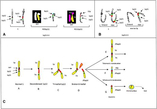 Figure 2. Partial karyotypes from controls 2 and 3 demonstrating the origin of JT1q12 and a model for the origin of 1q12 aberrations. (A) Partial karyotypes of control # 2 demonstrating CN gains of 1q21 and CN losses in RCs. Normal chromosomes 1 (left bracket), RC9(q11) by both SKY (chromosome 1 yellow, chromosome 9 white) and FISH (9q11) (aqua) (middle bracket), and progression of CN aberrations resulting from an additional jump of JT1q12 to the RC12(q11) (SKY, chromosome 12 pink) and FISH (right bracket). CN of 1q21 is 4 with the loss of both 9q and 12q in the RCs. (B) Control 3 shows a chromosome 1 by both G-banding and FISH (left bracket) with a 1q21 CN of 2 resulting from a JT1q12 to the telomere of 1p and an isochromosome 1q (right bracket). (C) Model for the origin of CN gains of 1q21. Characterization of aberrations is identified following hypomethylation of 1q12 pericentromeric heterochromatin. Normal chromosome 1 (A) is depicted with a centromere (black) and FISH probes 1q12 (red) and 1q21 (green) (far left). Transient aberrations include cells with decondensation of the 1q12 region (B), triradials of 1q12 resulting in a CN gain of 1q21 (C), and cells with breakage in the 1q12 (red) pericentromeric heterochromatin (D). Extra copies of the JT1q12 originating from a triradial usually either translocate to the telomeric region of an RC (E) or alternatively to the pericentromeric region of an RC (F). Copies of JT1q12s that do not successfully translocate to an RC (G) result in acentric copies of chromosome 1q21 and are subsequently encapsulated into micronuclei and lost from the cell. FISH hybridizations to metaphase chromosomes are shown in inverse 4,6 diamidino-2-phenylindole to delineate G-banding patterns.