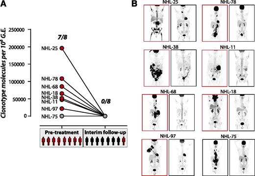 Figure 4. Limits of disease detection during therapy. (A) Tumor clonotype was detected at varying levels within 1 mL of plasma from 7 of 8 patients before treatment. At an interim time point after 4 cycles of R-CHOP, disease was not detectable in any patient (red circles, detectable molecular disease; gray circles, undetectable molecular disease; red patients, detectable disease on PET/CT; black patients, no detectable disease on PET/CT). (B) PET/CT scans show the disease burden for 8 patients before treatment (left) and after 4 cycles of R-CHOP (right). NHL-75, with no tumor clonotype detected within the plasma at diagnosis, can be seen to have a large tumor burden. Although no patients had detectable disease at the interim time point, 1 case showed residual disease by PET scan. This patient relapsed 376 days later (NHL-11). Two additional cases showed no disease by PET/CT at the interim time point but went on to relapse 247 (NHL-75) and 267 days (NHL-68) later.