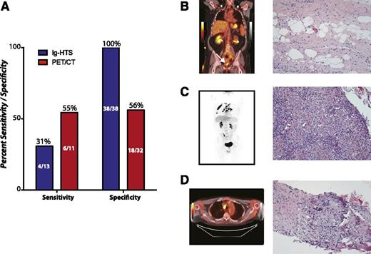 Figure 6. Superior specificity of Ig-HTS compared with PET/CT. (A) A comparison of the sensitivity and specificity of Ig-HTS and PET/CT in patients who had both tests performed during clinical surveillance, with the performance assessed by ultimate clinical outcome of the patient. PET/CT can be seen to have superior sensitivity to Ig-HTS, but the specificity of Ig-HTS was 100% and greater than that of PET/CT. (B-D) Examples of false-positive PET/CT scans with concurrent true-negative Ig-HTS. (B) A PET/CT of a patient in remission from stage IV DLBCL showed a positive signal at the site of previous disease (left, white arrow). Biopsy showed unremarkable fibro-adipose tissue. (C) A patient in remission from stage IV DLBCL with a positive PET/CT in the lungs (left) resulting from granulomatous inflammation (right). (D) A PET/CT of a patient in remission from stage IV DLBCL with signal in a para-aortic lymph node (left) that was shown to result from granulomatous lymphadenitis (right).