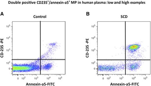 Erythrocyte MP quantification in human plasma by fluorescence-activated cell sorter (FACS). Erythrocyte MPs were quantified as annexin-a5+/CD235+ double-positive events by FACS in control and sickle cell disease plasma vs calibrated fluorescent microbeads body. (A-B) Examples of stained annexin-a5+ and CD235a+ events in plasma: (A) control plasma and (B) SCD plasma. Modified from supplemental Figure 1 in the article by Camus et al that begins on page 3805.