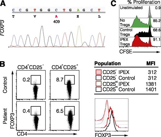 Figure 3. Identification of a novel variant in FOXP3 associated with IPEX syndrome. (A) Sequence of the FOXP3 gene in the IPEX patient. (B) FOXP3 expression in Tregs (CD4+CD25hi) and Tnaive (CD4+CD25−) from the IPEX patient and healthy control shown by flow cytometry (left) and histogram the mean fluorescence intensity (right). (C) In vitro suppression assay using Tregs from a healthy control or IPEX patient and carboxyfluorescein diacetate succinimidyl ester (CFSE)-labeled allogeneic responder T cells.