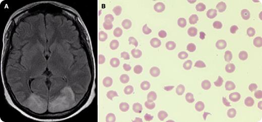 A 25-year-old woman with FLT3-ITD positive acute myeloid leukemia underwent cord blood transplantation with fludarabine, cyclophosphamide, and total body irradiation conditioning. Despite prophylaxis with mycophenolate and tacrolimus, she suffered from grade 4 gastrointestinal graft-versus-host disease that was managed with rabbit antithymoglobulin and extracorporeal photopheresis. She developed posterior reversible encephalopathy syndrome (PRES) manifesting with encephalopathy, seizures, and consistent brain magnetic resonance imaging (panel A) and thrombotic microangiopathic anemia (TMA) with schistocytes on peripheral blood smear (panel B), elevated lactate dehydrogenase, low haptoglobin, and normal ADAMTS13. Cessation of tacrolimus and administration of eculizumab led to the resolution of both. Subsequently, she died after complications from cytomegalovirus, Pneumocystis jirovecii, and enterococcus infections. / This case demonstrates the challenges and unique pathologies associated with allogeneic transplantation. Calcineurin inhibitors are known to cause PRES and TMA but the relationship between these pathologies is unknown. Our case highlights that after diagnosis of either, evaluation for the second should be considered.