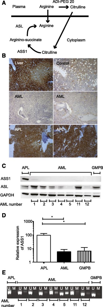 Figure 1. ASS1 is not expressed in most AML. (A) The 2 enzymes required for endogenous arginine synthesis are shown together with the products of arginine following ADI-PEG 20 therapy. (B) ASS1 expression was assessed in bone marrow using immunohistochemistry: positive control, liver (top left); control bone marrow (top right). The rest of the panels are pictures of trephines with the diagnosis indicated on each panel. The 2 AML samples are negative (middle right, sample T19; middle left, sample T22), whereas the 2 APL samples express ASS1 (bottom right, sample T3; bottom left, sample T2). Slides were analyzed using a Leica DM2500 microscope with ×100 magnification, and images were acquired by a Leica DFC320 camera and processed using Leica IM50 software. (C) The expression of ASS1 and ASL in primary AML lysates was tested using western blotting. Results for 7 AML, 1 APL, and 1 granulocyte–colony-stimulating factor mobilized peripheral blood (GMPB) samples are shown. (D) The relative expression of ASS1 was quantified by real-time PCR in 4 APL, 38 AML, and 11 GMPB samples. Relative expression of ASS1 was greater in APL than AML or GMPB. *P < .001. (E) Methylation of the ASS1 gene was assessed in 7 primary AML, 1 APL, and 1 GMPB samples. Six of 7 AML samples show some methylation, whereas the APL does not. U, unmethylated DNA; M methylated DNA.