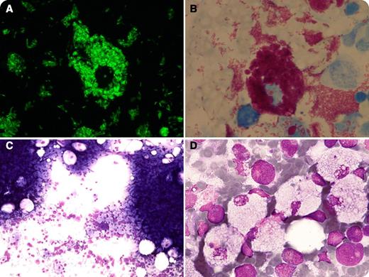 A 48-year-old HIV-positive male with a CD4 count of 100 cells per mm3 was admitted to the hospital for fever and dysphagia. Physical examination when he arrived in the emergency department revealed painful splenomegaly. Complementary examinations involving the rest of systems were normal. / His blood count showed a hemoglobin level of 100 g/L, white cell count of 2900/mm3, lymphocytes 1000/mm3, and platelets 87 000/mm3. Pancytopenia and fever in an immunocompromised patient made us suspect an opportunistic infection as a possible etiology. Routine blood cultures were performed for recovery of aerobic and anaerobic bacteria, which turned out to be positive for Streptococcus pneumoniae. Upper gastrointestinal endoscopy showed esophageal candidiasis. A bone marrow aspirate was performed. The smears were air-dried and stained with auramine (panel A), Ziehl-Neelsen (panel B), and Giemsa (panels C-D) stains. The smears stained with Giemsa stain showed innumerable macrophages filled with cytoplasmic structures that the Ziehl-Neelsen and auramine stains revealed as acid-fast bacilli. Simultaneously, the bone marrow aspirate was cultured for bacteria, fungi, and mycobacteria. The culture was positive for mycobacteria. DNA identification by polymerase chain reaction indicated the presence of Mycobacterium avium complex. Unfortunately, the patient died before starting a treatment.
