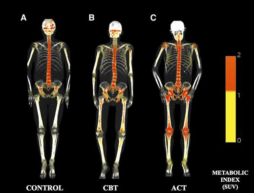 Figure 2. The 3D reconstructions of sample patients generated by the fusion of the automatically segmented FDG PET and CT data. Control subject (A) shows prevalent activity in the axial skeleton, whereas a patient treated with CBT (B) shows increased activity also in the hip bones and in the long bone shafts. (C) A patient treated with ACT shows a markedly increased glycolytic activity, extending up to the distal tibial epiphyses.