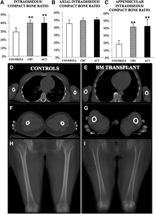 Figure 3. Structural alterations in patients with hematologic conditions. In both patient groups, cortical bone erosion was present, causing a significant increase in the ratio between intraosseous space and total SV (A). This difference was largely caused by marked erosion in the appendicular district (C), whereas the axial skeleton was unmodified (B). (D-G) Transaxial slices of a transplanted patient (E, G), showing visible cortical erosion, as compared with a matched control (D, F). (H-I) Mean intensity projections of a coronal slice of femurs, showing marked erosion in the transplanted patient (I), compared with control (H). Significance was represented as follows: *P < .05; **P < .01.