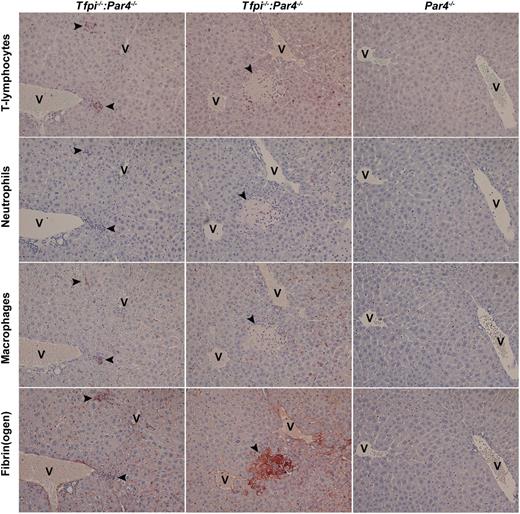 Figure 3. Sterile inflammatory infiltrates are present in the liver of Tfpi−/−:Par4−/− mice. Livers were isolated from Tfpi−/−:Par4−/− mice (first and second columns) and Par4−/− mice (third column) and processed for immunohistochemistry. Serial sections were stained for T lymphocytes (first row, CD3-positive cells), neutrophils (second row, Ly6B.2-positive cells), macrophages (third row; F4/80-positive cells), and fibrin(ogen) (fourth row). Two types of lesions were observed in Tfpi−/−:Par4−/− mice: smaller lesions containing predominantly CD3+ cells and macrophages that were associated with fibrin deposition (first column) and large, necrotic, fibrin-rich lesions containing neutrophils that were surrounded by CD3+ cells (second column). Staining of tissue from Par4−/− mice (third column) served as a control. In each image, lesions are indicated with arrowheads, and the central vein is indicated with the letter V. Slides were examined at room temperature using Olympus 10X UPlanFI and ×20 Plan objectives lenses mounted to a Olympus BX50 microscope. Coverslips were mounted using xylene-compatible mounting medium (Dako). Images were captured with a Nikon DS-Fi1 digital microscope camera and Nikon NIS Elements software (version 2.1).