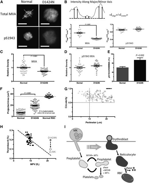 Figure 4. Characterization of abnormalities in MYH9-RD patient platelets. (A) Peripheral blood from a patient expressing c.4270G>A (D1424N) MYH9-RD mutation was collected in EDTA. Buffy coat was incubated with CD41-APC, anti-MIIA or anti-pS1943, and Hoechst 33342. Platelets were identified as CD41+ Hoechst– (scale bar = 5 μm). (B) Peripheral MIIA is disrupted in platelets with the MYH9-RD mutation. Intensity line scans were made along perpendicular major and minor axes as shown. MIIA distribution is quantified by the ratio of average peripheral intensity to average center intensity. Total MIIA is peripheral in normal platelets and diffuse in mutant platelets, and phospho-MIIA is diffuse in either case. MYH9-RD mutation results in a decrease in total MIIA (C) but not in pS1943 MIIA expression (D). (E) Accounting for the maintenance of pS1943 density, but reduction in total MIIA, the patient platelets show an approximately twofold increase in percent of phosphorylated MIIA. (F) Patient platelets show an increase in projected area. (G) MYH9-RD mutation has a dramatic effect on observed platelet shape (Normal: n = 83; D1424: n = 78; RBC: n = 32). Normal RBCs were used as a calibration control for (E-F). RBCs, red blood cells. (H) Thrombocrit values calculated from mean platelet volume (MPV), and platelet count data show a weak dependence on MPV (linear regression: thrombocrit = −0.01 * MPV + 0.33, R2 = 0.12, n = 49).31 The red diamond is the value for the D1424N patient. If a compensatory mechanism of increased MK number applies as described for mouse,18 the MYH9-RD patients’ thrombocrit values also fit the trend of normal thrombocrit values. (I) Proposed model of platelet generation accounting for MYH9-RD induced macrothrombocytopenia, with MK shedding of preplatelets being analogous to erythroblast enucleation, where the circulating reticulocyte becomes a discocyte through the aid of hydrodynamic shear force. MIIA evidently has no role because RBCs appear normal in MYH9-RD blood. Blood shear forces likewise assist the transition from preplatelet to proplatelet, but MIIA drives cleavage furrow formation and fission, resulting in small normal platelets. MYH9-RD mutations abrogate normal MIIA activity, preventing cleavage furrow formation and platelet fission, thus causing an increase in circulating preplatelets and the phenotypic large platelets.