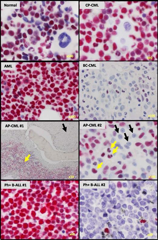 Figure 2. IKAROS protein is reduced in BM blasts from CML patients with advanced-phase myeloid disease, but not from patients with BCR-ABL1–negative AML. Immunohistochemical staining for IKAROS protein (magenta) in representative BM trephine biopsy sections counterstained with hematoxylin from normal BM and patients with CML in CP, AP, and myeloid BC as indicated, as well as patients with BCR-ABL1–negative AML and BCR-ABL1+ (Ph+) B-ALL. AP-CML #1 shows loss of IKAROS staining in the primitive cells in the paratrabecular regions (black arrow) in contrast to strong IKAROS staining in the residual maturing CP-CML cells (yellow arrow). AP-CML #2 similarly shows loss of IKAROS in blasts (black arrows), but not in residual maturing cells (yellow arrows). The original magnification is shown on the bottom right of each panel.