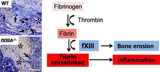 The coagulation fXIII is a crucial determinant of inflammation and bone erosion in rheumatoid arthritis in mice. Although reduced inflammation is a common feature between fibrinogen-deficient and fXIII-deficient mice after CIA, reduction of osteoclasts is a unique feature of fXIII-deficient mice. Histologic images are from Figure 5A in the article by Raghu et al that begins on page 427.