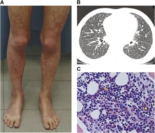 Figure 1. Clinical characteristics of patients. (A) Livedo-like generalized exfoliating dermatitis in patient 1. The rash culminates in limb extensor areas. (B) High-resolution computed tomography of patient 2 showing ground-glass opacity, bronchoalveolar thickening, and increased nodularity. (C) BM biopsy from patient 1 showing modest BM eosinophilia despite observed peripheral eosinopenia (yellow asterisks). Hematoxylin and eosin stain, original magnification ×40.