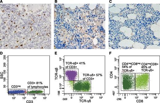 Figure 3. Abnormal lymphocyte populations detected in STAT3-mutated patients. (A-C) BM biopsy shows abnormally high number of phospho-STAT3–positive lymphocytes both in patient 2 (p.K392R) (A) and, to a lesser extent, in patient 1 (p.K658N) (B). Patient 3 (M394T) was not available for study. In healthy BM, no phospho-STAT3 cells are present (C). (D-F) Flow cytometry results from patient 2 (p. K392R). The majority of lymphocytes were CD3+ (A), with 57% of the population expressing TCR-γδ (B). The TCR-γδ+ population consisted of CD4−CD8− and CD4−CD8+ T cells. The expression of TCR-γδ was considerably lower in CD4−CD8− cells than in CD4−CD8+ T cells; therefore, 2 populations are seen in the scatter plot. (C). In healthy individuals, TCR-γδ–expressing T cells account less than 6% of all CD3+ T cells and the TCR-γδ expression is normally uniform. ×40 magnification, hematoxylin and eosin stain.