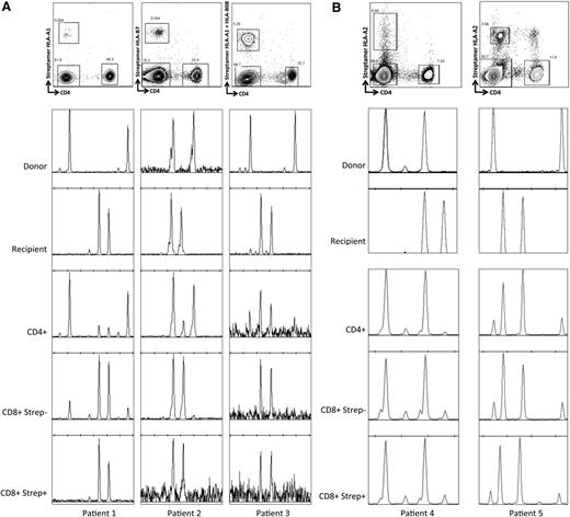 Figure 5. CMV-specific T cells are of recipient origin after R+/D− HSCT but of both recipient and donor origin in the context of R+/D+ HSCT with mixed chimerism. (A) The upper panels illustrate the strategy used for sorting T-cell populations (pregated on CD3). Chimerism patterns are shown for donor and recipient, and subsequently for the selected T-cell populations at 6 months after HSCT. The CD8+ compartment is more skewed toward recipient chimerism than the CD4+ compartment, and the streptamer+ (CMV-specific) CD8+ cells show 100% recipient chimerism. (B) In contrast, in the setting of mixed chimerism after R+/D+ transplants, the CMV-reactive CD8+ T cells (streptamer+) come from both donor and recipient compartments, and the recipient chimerism levels were similar in the different cellular compartments (patient 4: CD4+ 4%, CD8+streptamer− 13%, CD8+streptamer+ 13%; patient 5: CD4+ 80%, CD8+streptamer− 86%, CD8+streptamer+ 85%).