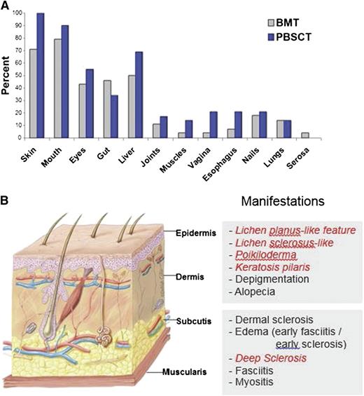 Figure 1. The frequency of involvement by chronic GVHD varies across organs and sites and is higher after HCT with mobilized blood cells as compared with marrow. (A) The most frequently involved organs and sites are the skin, mouth, eyes, gastrointestinal tract, and liver.3 (B) Chronic GVHD can affect all layers of the skin. Photographs of each manifestation in italic may be found in the supplemental Data, available on the Blood Web site. Artwork by Delilah Cohn, MFA, CMI, used with permission.