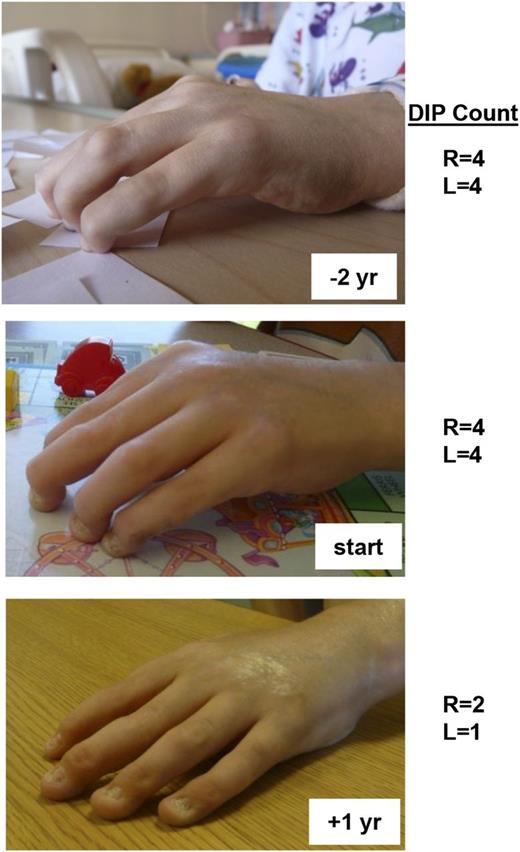 Figure 5. Patient response to anti-IL6R monoclonal antibody therapy. Patient 1 received therapy with the anti-IL6R monoclonal antibody tocilizumab. He had notable improvement of his long-standing polyarthritis and skin tightening as shown in the photographs (top, 2 years before treatment; middle, at initiation of treatment; and bottom, after one year of treatment). Indicated are the number of fixed DIP (distal interphalangeal) contractures of both his right and left hands at the designated times with respect to anti-IL-6R therapy. L, left; R, right; yr, year.