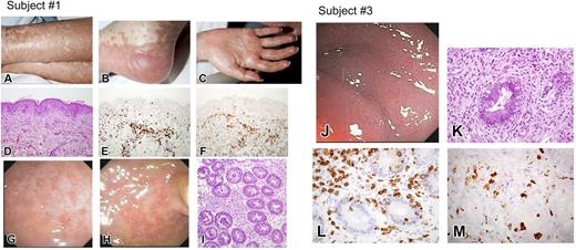 Figure 2. Gross and histologic evidence of aGVHD. (A-I) Subject 1. Photographs of skin lesions (A-C) show palmar and solar erythema, and edema and bullous lesions in the lower extremities. Photomicrographs (all 200×) of hematoxylin and eosin (H&E) (D), anti-CD3 (E), and anti-CD56 (F) stained sections of skin involved with GVHD. There is basal vacuolization of the epidermis, apoptosis of epidermal keratinocytes, and infiltration of T cells and NK cells around dermal vessels and along the dermal–epidermal junction. Exocytosis—infiltration of lymphocytes into the epidermis—is also seen. (G-I) Photographs taken during flexible sigmoidoscopy that demonstrate severely congested, erythematous, eroded, granular, and inflamed mucosa in the rectum and distal sigmoid colon. Colonic biopsy (I) shows apoptotic crypt injury and crypt loss (H&E, ×200). (J-M) Subject 2. Photograph from colonoscopy (J) demonstrates congestion and mildly erythematous rectal mucosa. Colonic biopsy photomicrographs of H&E (K, ×400), anti-CD3 (L, ×600), and anti-CD56 (M, ×600). Crypt injury with epithelial apoptosis and crypt loss is observed, with infiltration of T and NK cells within and around injured crypts.
