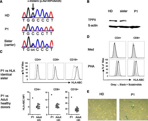 Figure 1. Human TPP2 deficiency reproduces features of the murine knockout phenotype. (A) Illustration of the single nucleotide deletion at position c.432delG of the TPP2 coding sequence in the index patient (P1) and his asymptomatic sister. (B) Western blot analysis of lysates from Epstein Barr virus (EBV) lines of P1, the healthy heterozygous sister, and a healthy donor (HD) incubated with anti-TPP2 antibodies (upper panel) and anti-actin antibodies as a loading control (lower panel). (C) MHC class I expression on fresh T and B cells of P1 compared with his HLA identical healthy heterozygous sister or 10 adult controls (adult HD). (D) Upregulation of MHC class I expression on control CD4 or CD8 T cells after phytohemagglutinin (PHA) stimulation in the absence (gray) or presence (black) of the TPP2 inhibitor butabindide. (E) β-galactosidase activity of primary fibroblasts isolated from skin biopsies of the patient (P1) or a healthy donor (HD). Experiments (C-E) were performed 3 times with similar results. ABCs, age-associated B cells; Max, maximum; Med, medium; TPPII, tripeptidyl peptidase II.