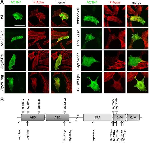 Figure 1. Functional studies of novel ACTN1 variants. (A) Immunofluorescence analysis in PD220 fibroblast cell line transiently transfected according to standard procedures. Both wild-type (wt) or mutant ACTN1 cDNAs were cloned into the pcDNA3.1-Myc tagged expression vector.5 The subcellular localization of exogenous α-actinin 1 (green) was examined using c-myc antibodies (9E10; Santa Cruz Biotechnology), whereas the actin filaments were stained with AlexaFluor594 (red) conjugated phalloidin (Invitrogen). Images were obtained with a Nikon C1si confocal microscope, using ×60 Plan Apo objectives. Images were processed for z-projection (maximum intensity), brightness, and contrast regulation, using ImageJ 1.45 (National Institutes of Health). The cells shown are representative of 3 independent experiments. Scale bar = 50 µm. (B) Domain structure of α-actinin and localization of ACTN1 mutations identified in Japanese families (arrowheads)5 and in this article (arrows). The p.Arg46Gln mutation was also identified in a French family.6 α-actinin is organized in an actin-binding domain (ABD) at the N terminus, 4 spectrin repeats, and a calmodulin-like domain (CaM) at the C terminus. Antiparallel molecules dimerize in rod-like structures with the ABD at each extremity for cross-linking the actin filaments into bundles.