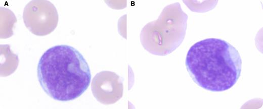 A 61-year-old man presented with left-side neck pain and swelling, dizziness, night sweats, and significant weight loss. His laboratory investigations showed pancytopenia with hemoglobin of 8.6 g/dL, leukocyte count of 600 per μL, and platelet count of 15 000 per μL. Bone marrow aspiration and biopsy revealed 90% blasts (panel A) with a peculiar “cup-shaped” nuclear morphology (panel B). Molecular diagnostics revealed the presence of cooccurring mutations of the nucleophosmin (NPM1) and Fms-like tyrosine kinase (FLT3) genes. Cytogenetic studies did not show any abnormalities. The patient was started on induction chemotherapy with cytarabine and idarubicin and demonstrated good response. / Acute myeloid leukemia is a complex diagnosis with several qualifiers including morphology, immunophenotype, and genetics. Cases with cup-shaped nuclear morphology are strongly associated with cooccurring mutations of NPM1 (internal tandem repeats within juxtamembrane domain or activating point mutations in the tyrosine kinase domain) and FLT3 (typically insertions or deletions of 4-9 bp). This morphology can be associated with solitary NPM1 but generally not FLT3 mutation on its own. In addition, this myeloid leukemia generally demonstrates a normal karyotype, high D-dimer levels, and negative CD34 and HLA-DR expression. Because of these unique characteristics, recognition of this morphology and subsequent FLT3 and NPM1 mutation testing are recommended.