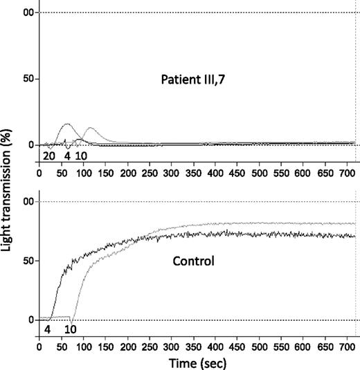Figure 2. ADP-induced platelet aggregation in PRP from a normal control and from patient III-7. Numbers below the aggregation tracings indicate the concentration of ADP added (µM). These experiments were performed using the light transmission aggregometer APACT 4 (Labor Fibrintimer).