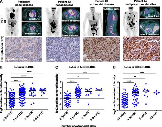Figure 4. c-Jun is enriched in extranodal lymphoma. (A) Positron emission tomography/computed tomography (PET/CT) images from patients with different lymphoma localization. Patients #1 and #2 had only nodal sites of involvement; representative images are shown. Patient #3 had multifocal extranodal involvement in the bone marrow in the spine, as shown in sagittal images. Patient #4 had multiple extranodal sites of involvement, including bone marrow, subcutaneous tissues, and perineural spread. Expression of p-c-Jun (Ser73) in DLBCL tumor tissues from these patients was determined by immunohistochemistry; representative images are shown (×500). (B-D) Expression of c-Jun was stratified by the number of extranodal sites using microarray data available in a public repository (GSE10846). Log2 median-centered intensities of c-Jun (probe 201465_s) in 296 cases with a known number of extranodal sites were obtained by using Oncomine v4.5 (www.oncomine.org). Patients diagnosed with the ABC or GCB subtypes of DLBCL were analyzed in (C) and (D), respectively. Statistical significance was evaluated by using two-tailed Student t test. ****P < .0001; ***P < .001; **P < .01; *P < .05.