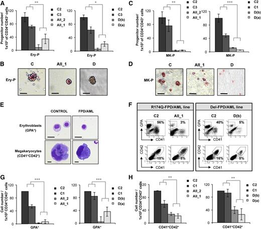 Figure 1. Deep decrease in erythroid and MK potential of progenitors derived from FPD/AML iPSC lines. AII_1 and AII_2 are iPSC clones of 2 patients from pedigree A; D(a) and D(b) are 2 clones of 1 patient from pedigree D; and C1, C2, and C3 are control iPSC lines. Cell numbers were normalized in all experiments to those produced by the C2 clone, which was reported in each experiment as a fixed value of 100. (A-D) CD34+CD43+ cells sorted at day 11 and tested for their colony-forming potential. (A-B) Methylcellulose assay. (A) The histograms present the numbers of erythroid progenitors (Ery-P) in 1 representative experiment of 3, each in triplicate. (B) Pictures of primitive erythroid colonies (Ery-P). (C-D) Fibrin clot culture. (C) The histograms present the numbers of MK progenitors (MK-P) in 1 representative experiment of 4, each in triplicate. (D) Pictures of primitive MK colonies (MK-P) after CD41 immunostaining. (A,C) Error bars represent ± standard deviation (SD) of triplicate. (B,D) Scale bar = 50 μm. (E-H) Analysis of hematopoietic populations at day 18 from progenitors sorted at day 11. (E) May-Grünwald-Giemsa staining of erythroblasts (GPA+) and MKs (CD41+CD42+) derived from iPSC lines. Scale bar = 10 μm. (F) Fluorescence-activated cell sorter (FACS) analysis of erythroid cells and MKs from FPD/AML iPSC lines in 1 representative experiment. (G) Absolute number of generated erythroid cells normalized to 1 × 102 plated progenitors. The histograms show average of the cell number obtained in 5 independent experiments for pedigree A and 3 for pedigree D. (H) Absolute number of generated MKs normalized to 1 × 102 plated progenitors. The histograms show average of the cell number obtained in 3 independent experiments for both pedigrees. (G-H) Error bars represent ± SD of the average. *P < .05; **P < .01; ***P < .001; Student t test.