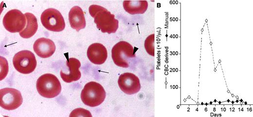 A 71-year-old patient with mantle cell lymphoma was treated in the setting of a randomized clinical trial protocol in which he received the combination of bendamustine and rituximab, with the addition of either ibrutinib or placebo. Four weeks after the first cycle, the patient developed severe pancytopenia. Bone marrow biopsy revealed a marrow devoid of hematopoietic cells, but with significant infiltration by lymphoma cells. Three days later, complete blood count showed a rapid apparent improvement in platelet counts, reaching 496 × 109/L within 6 days (panel B), while concurrent manual platelet count disclosed severe thrombocytopenia. The thrombocytopenia was accompanied by precipitates scattered throughout the film, occasionally attached to red blood cells (panel A, arrows). Some of these precipitates altered the erythrocyte morphology in a manner that can be misinterpreted as cell fragments (panel A, arrowheads). These findings suggested the presence of cryoglobulins that were indeed detected. Protein electrophoresis and immunofixation revealed an immunoglobulin M paraprotein. / Cryoglobulins are immunoglobulins that precipitate at temperatures below 37°C, producing high–molecular-weight aggregates. The precipitated cryoglobulin particles of various sizes may falsely be recognized as leukocytes or platelets causing pseudoleukocytosis and pseudothrombocytosis, respectively. In this patient, pseudothrombocytosis occurred, with the leukocyte counts being valid (0.4-3.6 × 109/L) throughout the event.