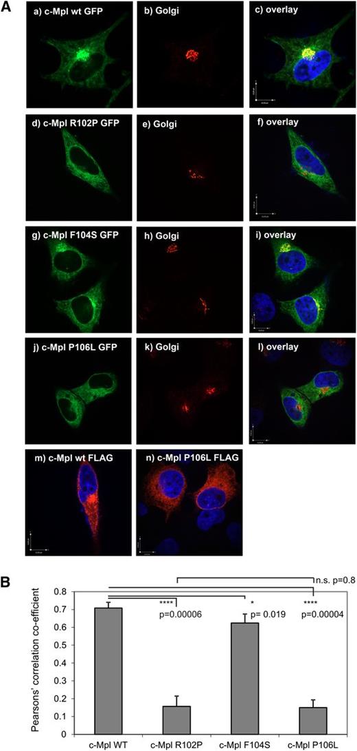 Figure 4. Different subcellular distribution and Golgi localization of c-Mpl WT and mutants. (A) Representative confocal images of transiently transfected HeLa cells. The c-Mpl-GFP minigenes harboring the green fluorescent protein (GFP) expression sequence in frame at the C-terminus were transfected as follows: (Aa-Ac) c-Mpl-WT-GFP, (Ad-Af) c-Mpl-R102P-GFP, (Ag-Ai) c-Mpl-F104S-GFP, and (Aj-Al) c-Mpl-P106L-GFP. The Golgi complex was visualized by a primary mouse antibody against of the Golgi-resident protein GM-130 and a secondary anti-mouse antibody coupled to Alexa 568 (Figure 4A, middle panels Ab, Ae, Ah, and Ak). The panels on the right (Ac, Af, Ai, and Al) represent overlays with the c-Mpl mutants and the Golgi marker. Interfering influence of the GFP-fusion protein on the subcellular distribution was excluded by FLAG-tagged (Am) c-Mpl WT-FLAG and (An) c-Mpl P106L-FLAG constructs harboring the FLAG-Tag at the C-terminus. The FLAG-tag was visualized by a mouse anti-FLAG M2 antibody and a secondary anti-mouse antibody coupled to Alexa 568 as described in “Materials and methods.” The nucleus was visualized by 4,6 diamidino-2-phenylindole staining. Bars in the overlay pictures represent 10 µm. Images were acquired using a Perkin Elmer spinning-disc confocal microscope with a ×100 Nikon oil immersion objective. Cells depicted are representative of the subcellular distribution pattern seen in >90% of the transfected cells. (B). Pearson’s correlation coefficient for the cotransfection experiments described in (Aa-Al) (n = 5). The coefficient was acquired from the Volocity 5.5 software using the automatic threshold function. The complete depicted panel was defined as region of interest (ROI) for the measurements.
