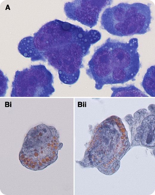 A 57-year-old man, treated 3 years earlier with chemotherapy and autologous bone marrow transplant for immunoglobulin A/λ multiple myeloma, presented with right facial numbness, left lower extremity numbness, and a palpable right preauricular mass. Brain magnetic resonance imaging demonstrated multiple foci of intraparenchymal enhancements with possible leptomeningeal involvement, numerous bone metastases, and a mass superior to the right parotid gland. / Cerebrospinal fluid slides were stained by a modified Romanowsky stain (panel A) and Papanicolaou stain (for cytology; panels Bi-ii) and revealed numerous anaplastic plasma cells characterized by abundant deeply basophilic cytoplasm, marked nuclear contour irregularity, and prominent nucleoli. Some cells contained variably sized, spherical cytoplasmic inclusions (Russell bodies), which appeared light blue using Romanowsky stain (panel A). Interestingly, the Russell bodies appeared orange when Papanicolaou stain was used (panels Bi-ii), which to our knowledge has not been reported previously. Flow cytometric analysis of cerebrospinal fluid demonstrated monoclonal plasma cells with an immunophenotype of CD45(+), CD38(+), cytoplasmic λ(+), CD19(−), CD20(−), and CD56(−). The patient died 3 months later.